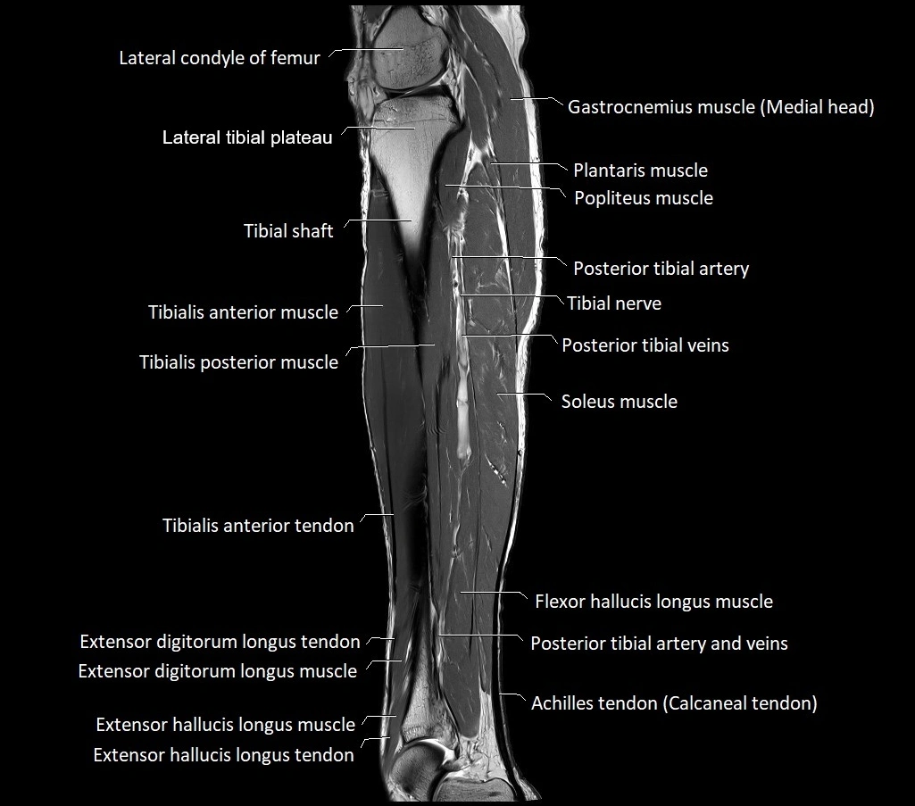 Lower leg sagittal anatomy 3T MRI image 16.webp